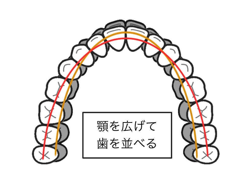 歯列の幅の広げる