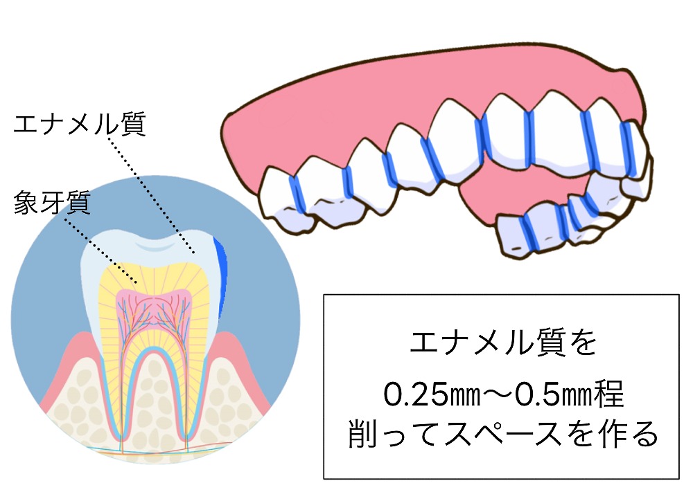 歯を僅かに削る（IPR・ディスキング）