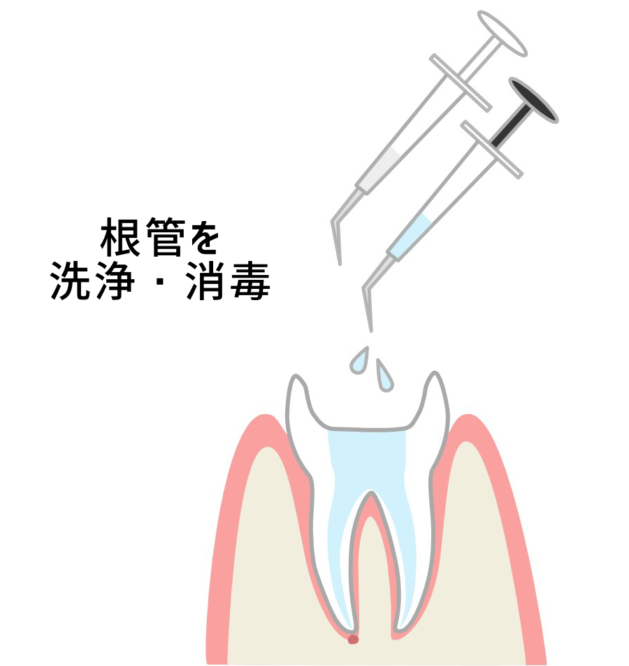 洗浄・消毒